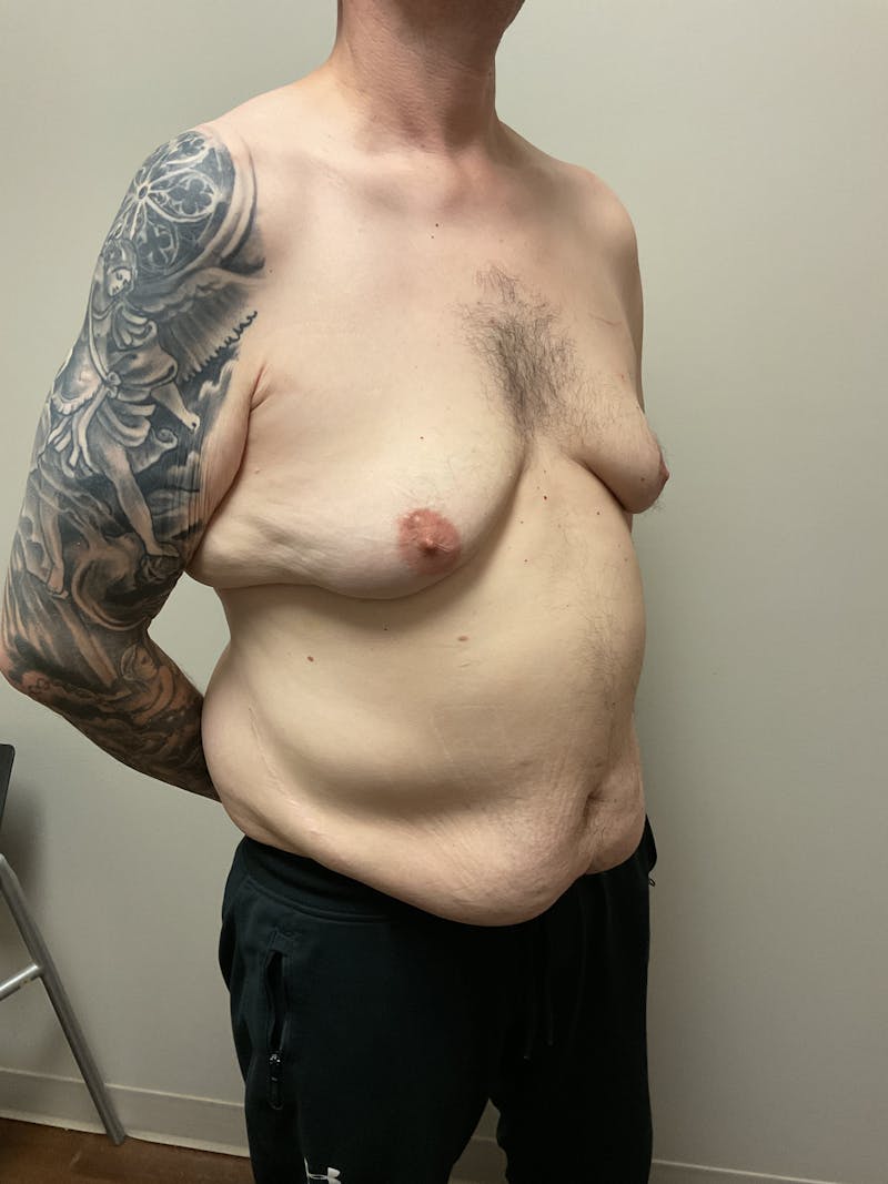 Gynecomastia Before & After Gallery - Patient 120675 - Image 9