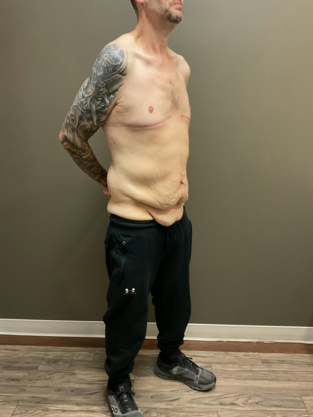 Gynecomastia Before & After Gallery - Patient 120675 - Image 10