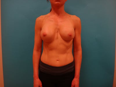 Mastopexy and Breast Asymmetry Before & After Gallery - Patient 384602 - Image 2