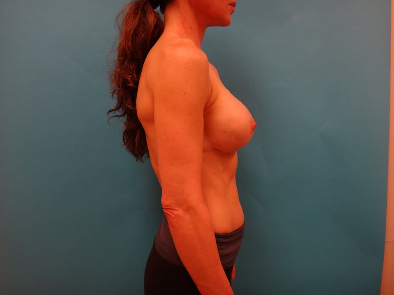Mastopexy and Breast Asymmetry Before & After Gallery - Patient 384602 - Image 6