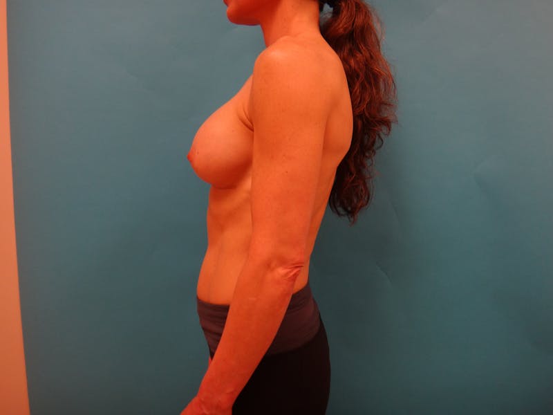 Mastopexy and Breast Asymmetry Before & After Gallery - Patient 384602 - Image 8