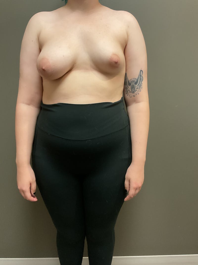 Mastopexy and Breast Asymmetry Before & After Gallery - Patient 348106 - Image 1