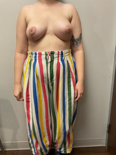 Mastopexy and Breast Asymmetry Before & After Gallery - Patient 348106 - Image 2