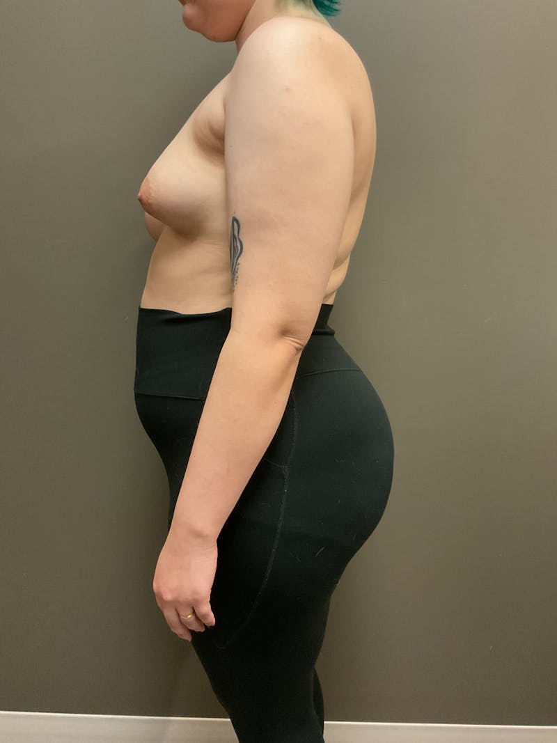 Mastopexy and Breast Asymmetry Before & After Gallery - Patient 348106 - Image 3