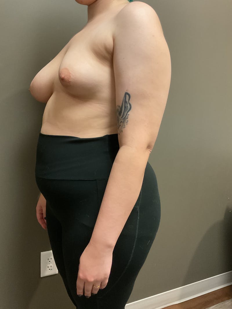 Mastopexy and Breast Asymmetry Before & After Gallery - Patient 348106 - Image 5