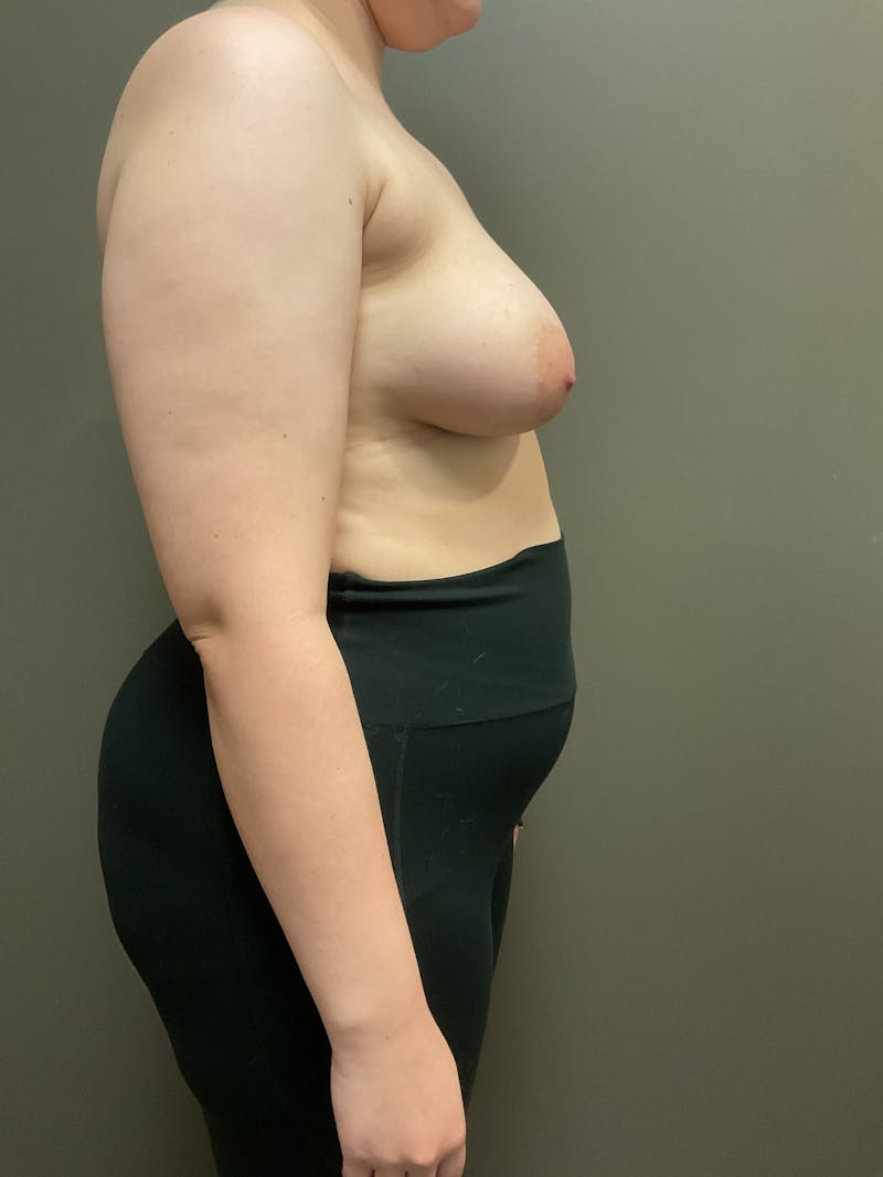 Mastopexy and Breast Asymmetry Before & After Gallery - Patient 348106 - Image 7
