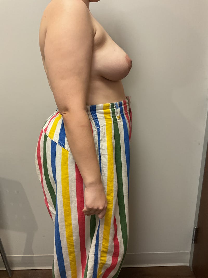 Mastopexy and Breast Asymmetry Before & After Gallery - Patient 348106 - Image 8