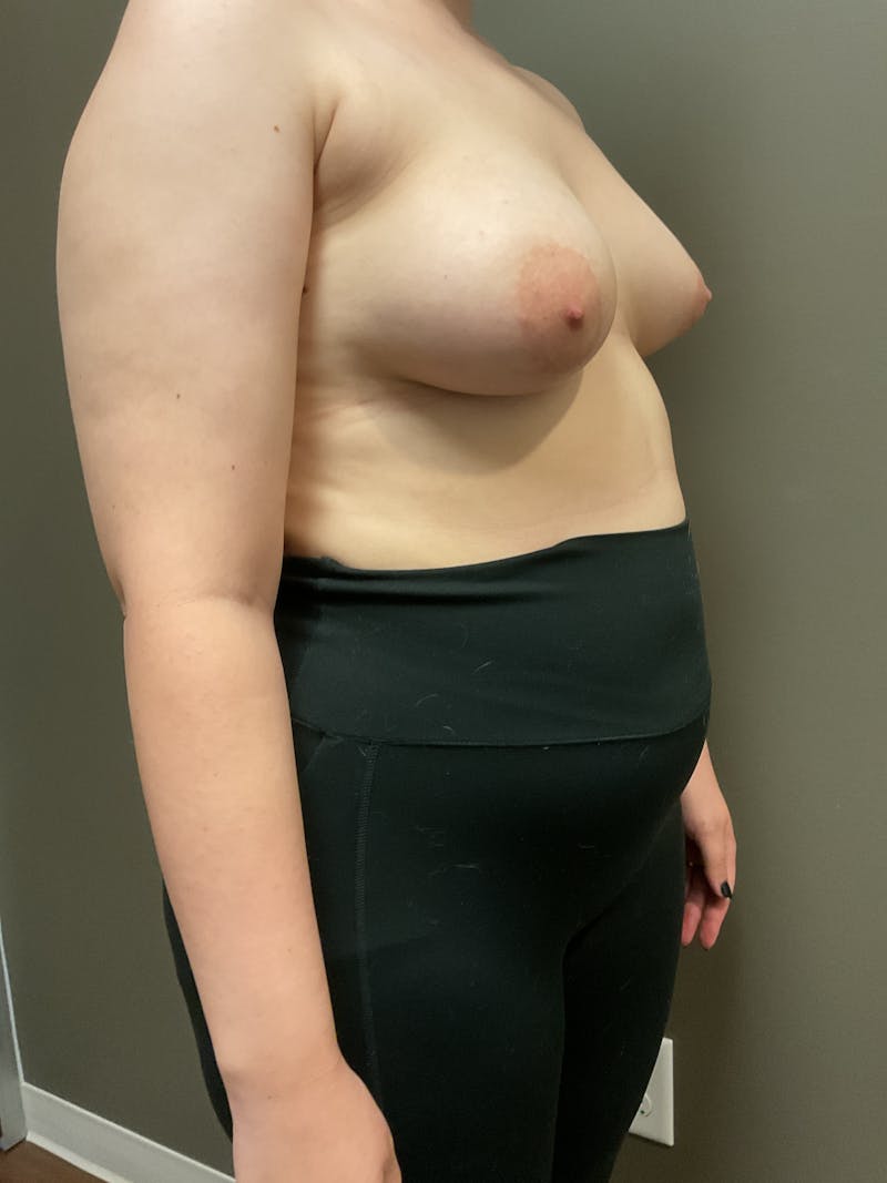 Mastopexy and Breast Asymmetry Before & After Gallery - Patient 348106 - Image 9