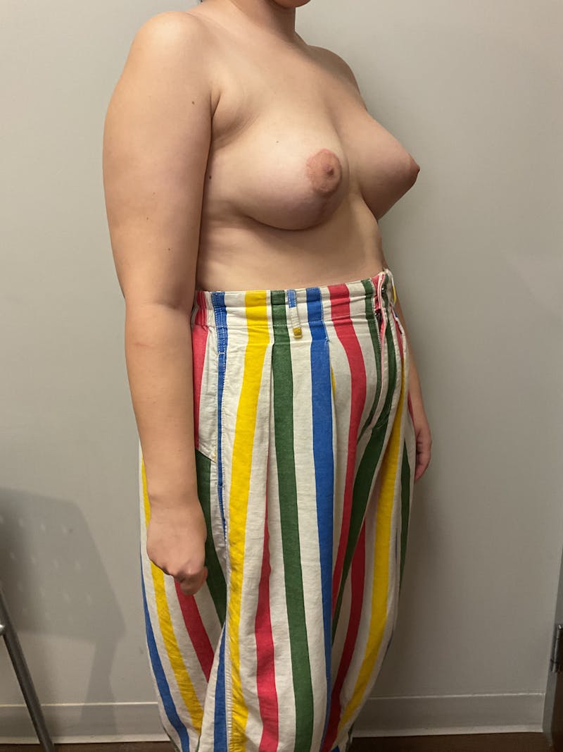 Mastopexy and Breast Asymmetry Before & After Gallery - Patient 348106 - Image 10