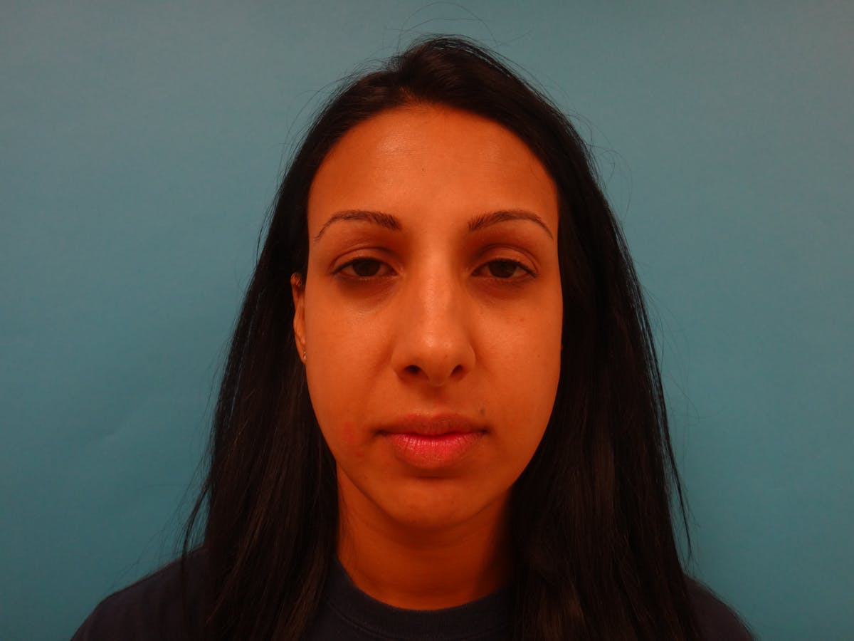 Rhinoplasty Before & After Gallery - Patient 104170 - Image 1