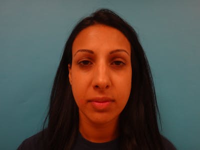 Rhinoplasty Before & After Gallery - Patient 104170 - Image 1