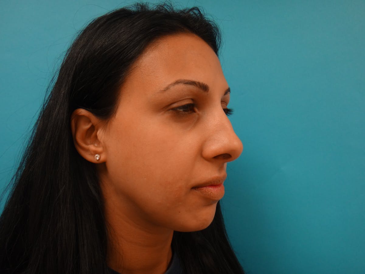 Rhinoplasty Before & After Gallery - Patient 104170 - Image 3
