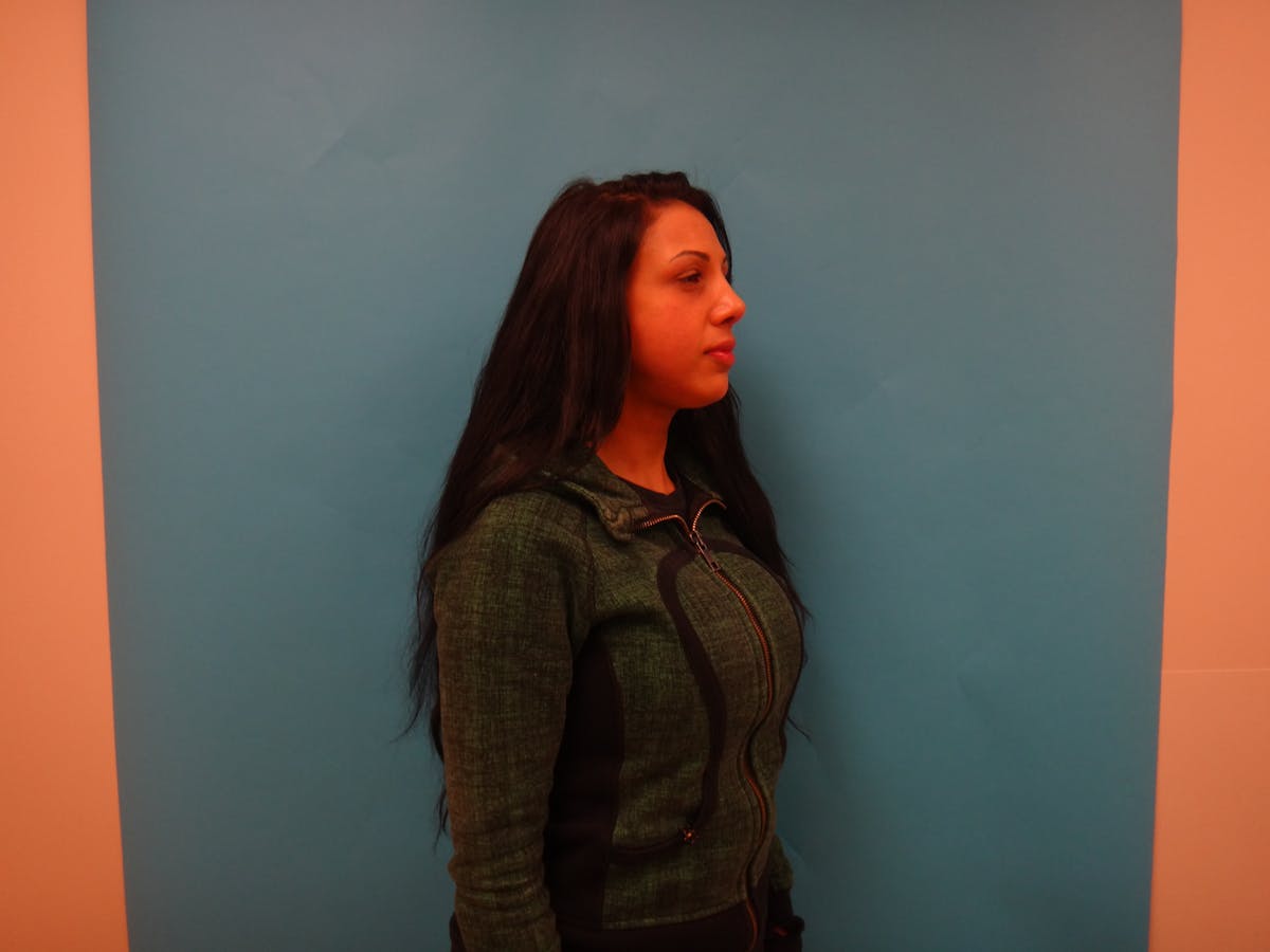 Rhinoplasty Before & After Gallery - Patient 104170 - Image 4