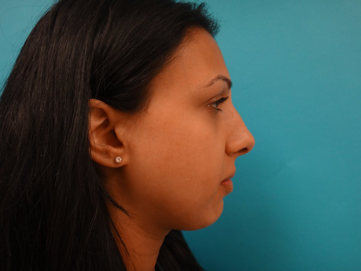 Rhinoplasty Before & After Gallery - Patient 104170 - Image 5