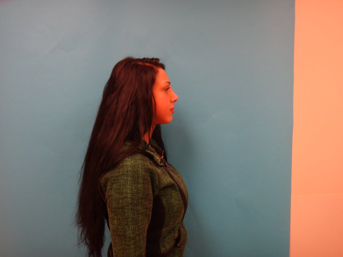 Rhinoplasty Before & After Gallery - Patient 104170 - Image 6