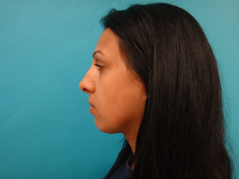 Rhinoplasty Before & After Gallery - Patient 334492 - Image 7