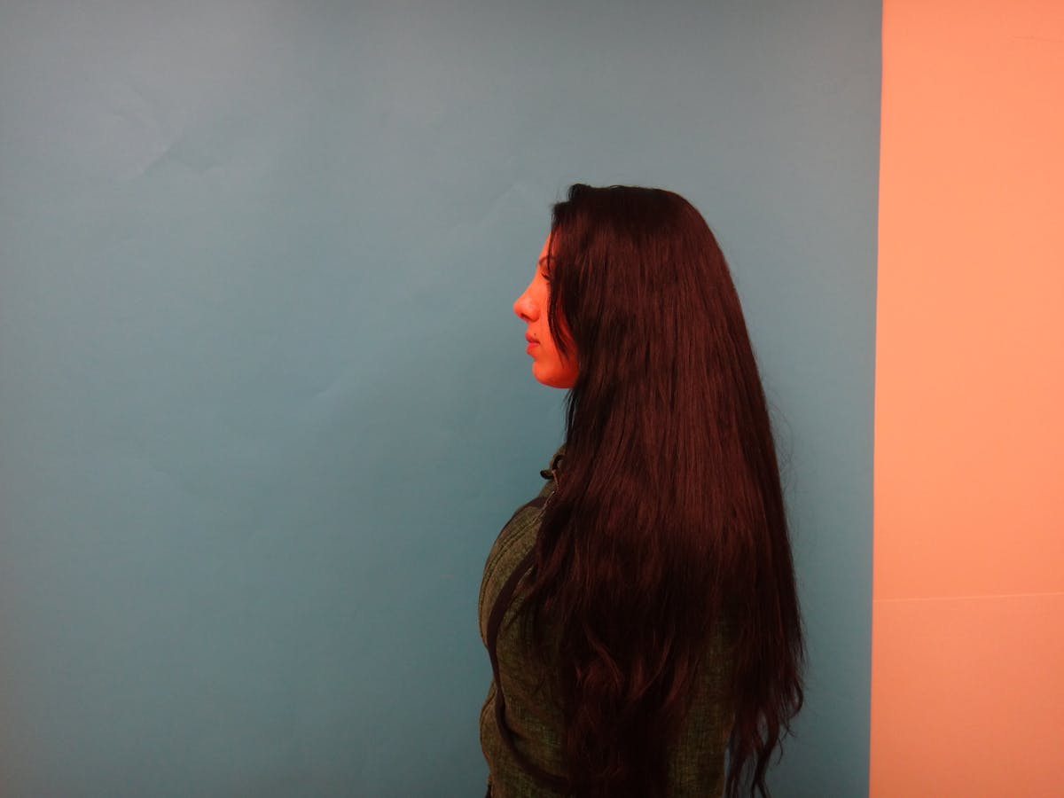 Rhinoplasty Before & After Gallery - Patient 104170 - Image 8