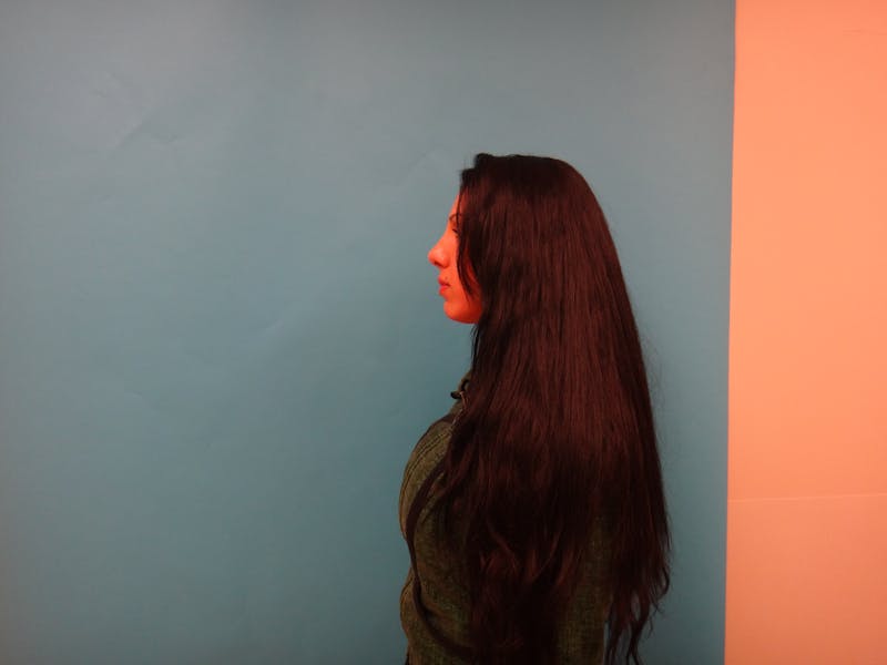 Rhinoplasty Before & After Gallery - Patient 334492 - Image 8