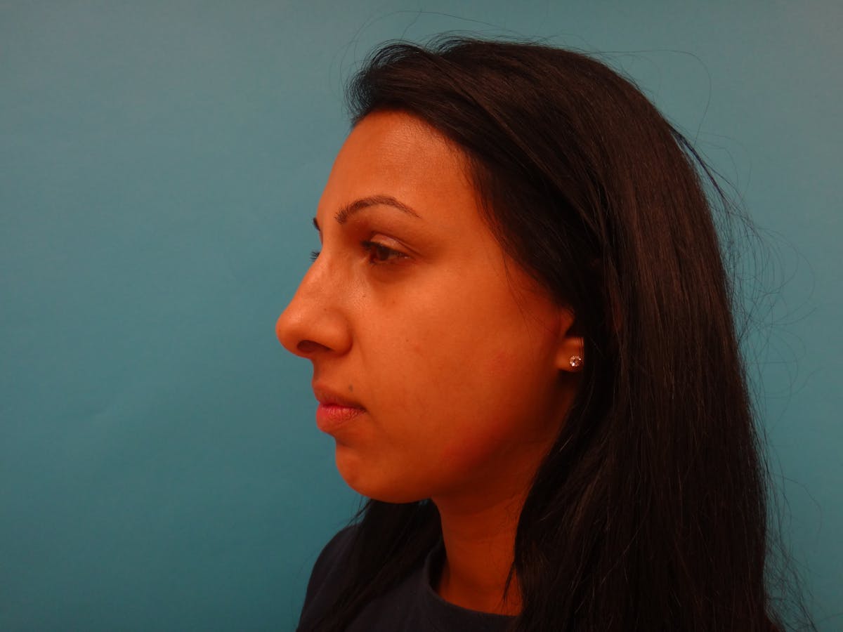 Rhinoplasty Before & After Gallery - Patient 104170 - Image 9