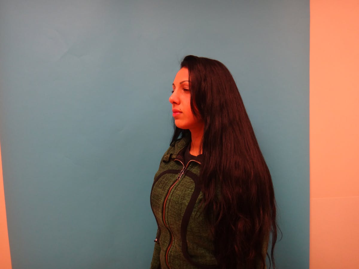 Rhinoplasty Before & After Gallery - Patient 104170 - Image 10