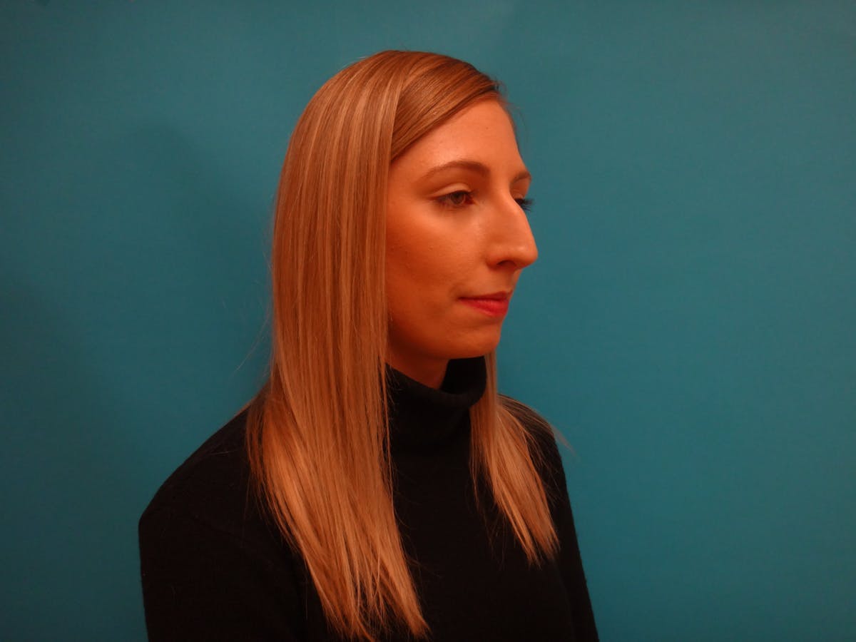 Rhinoplasty Before & After Gallery - Patient 253602 - Image 3