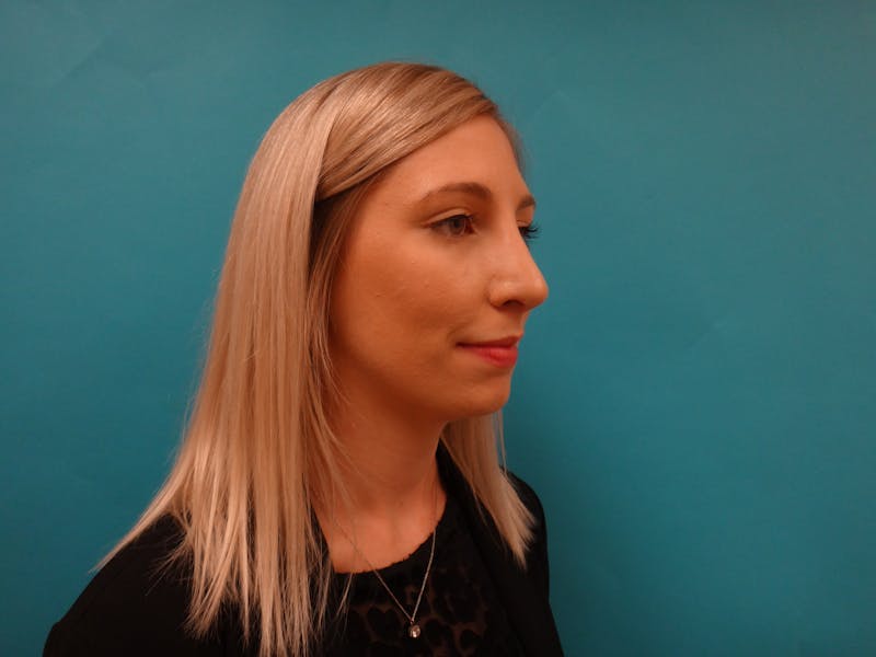 Rhinoplasty Before & After Gallery - Patient 238523 - Image 4