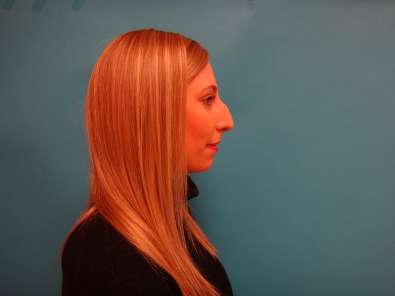 Rhinoplasty Before & After Gallery - Patient 238523 - Image 5