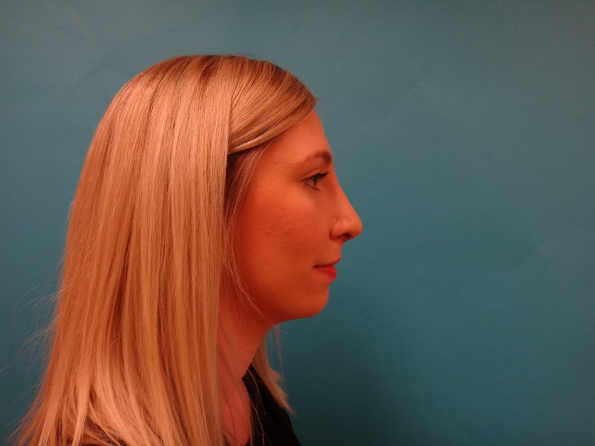 Rhinoplasty Before & After Gallery - Patient 253602 - Image 6