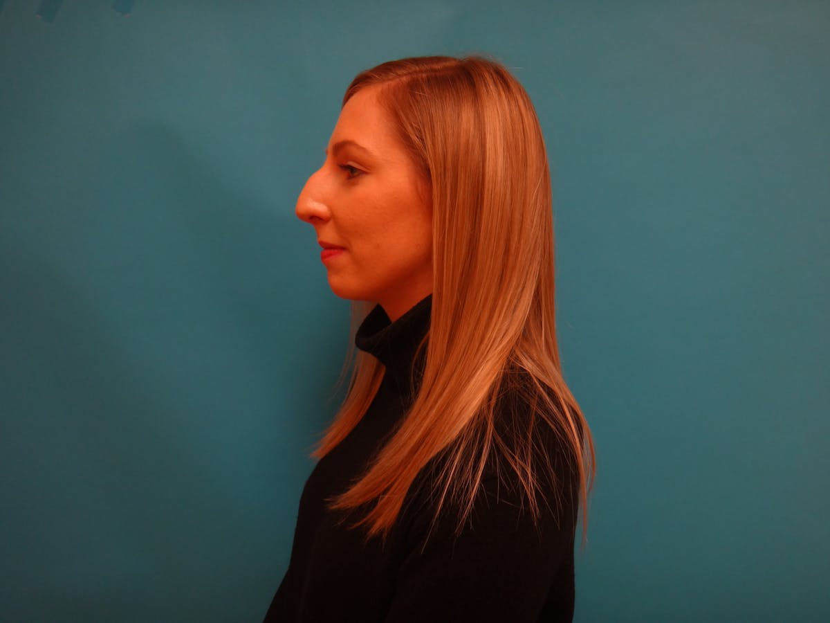 Rhinoplasty Before & After Gallery - Patient 253602 - Image 7