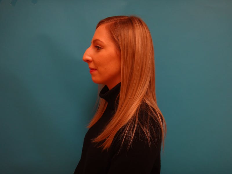 Rhinoplasty Before & After Gallery - Patient 238523 - Image 7
