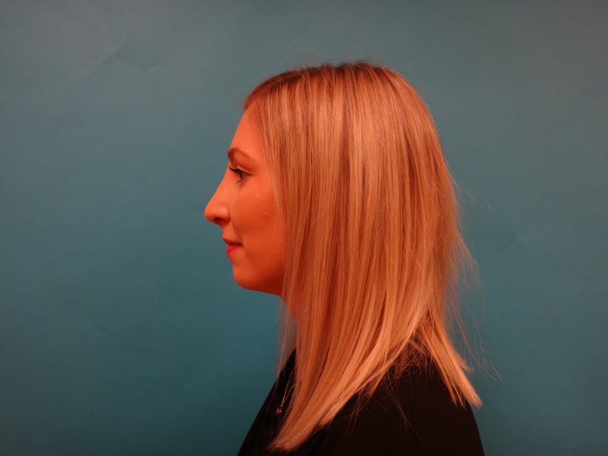 Rhinoplasty Before & After Gallery - Patient 253602 - Image 8