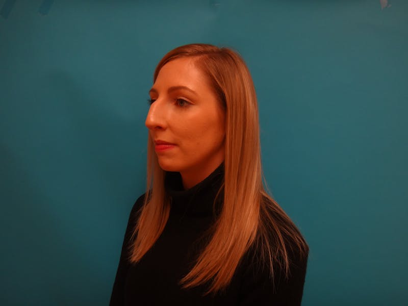 Rhinoplasty Before & After Gallery - Patient 238523 - Image 9