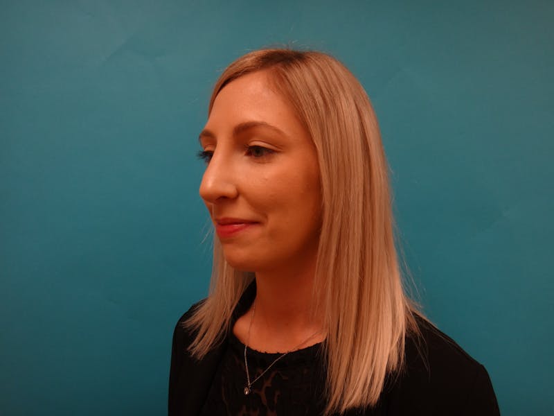 Rhinoplasty Before & After Gallery - Patient 238523 - Image 10