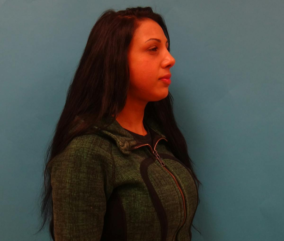 Rhinoplasty Before & After Gallery - Patient 104170 - Image 4