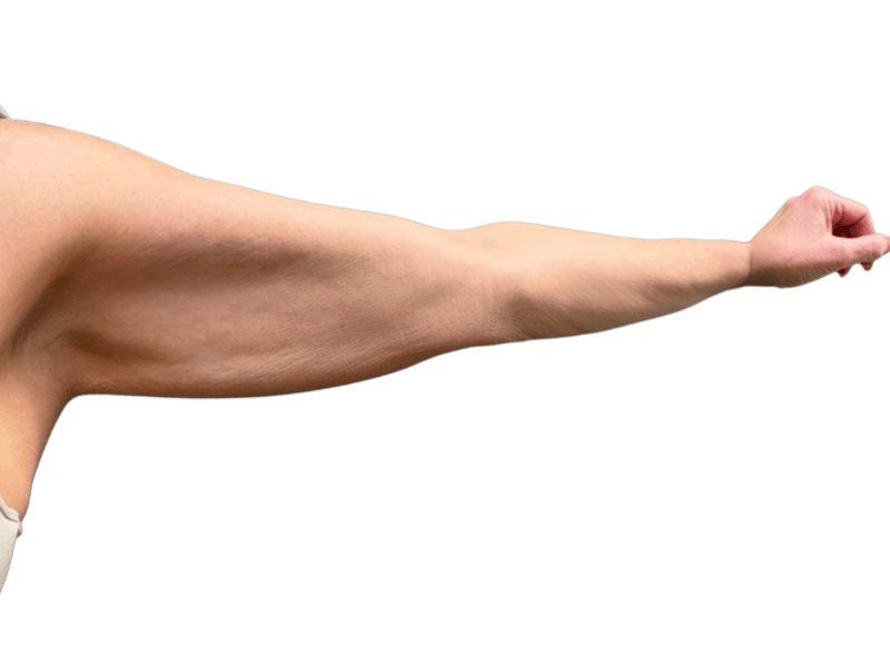Arm Lift (Brachioplasty) Before & After Gallery - Patient 198577 - Image 1
