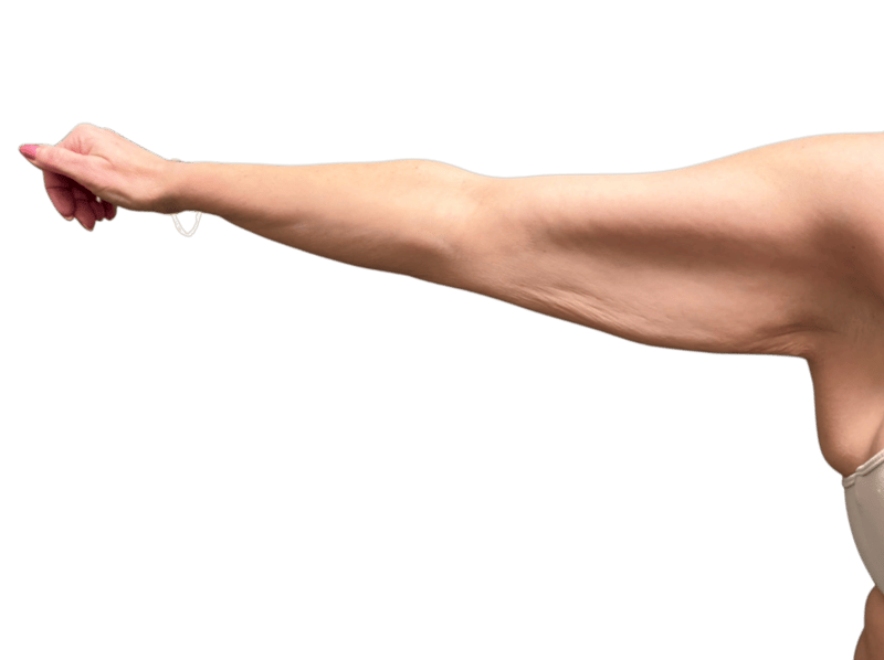 Arm Lift (Brachioplasty) Before & After Gallery - Patient 198577 - Image 3
