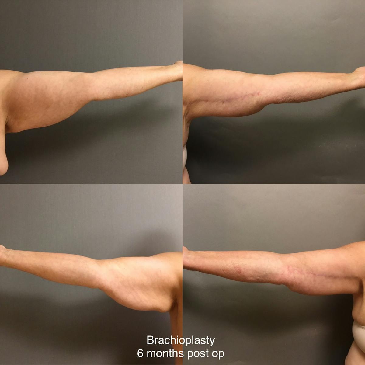 Brachioplasty Before & After Gallery - Patient 223007 - Image 3