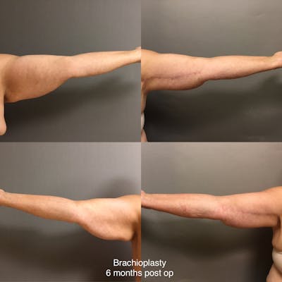 Brachioplasty Before & After Gallery - Patient 141628 - Image 1