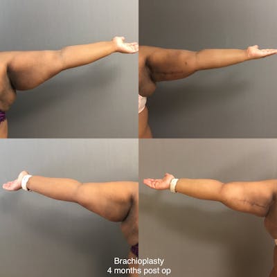 Brachioplasty Before & After Gallery - Patient 367772 - Image 1