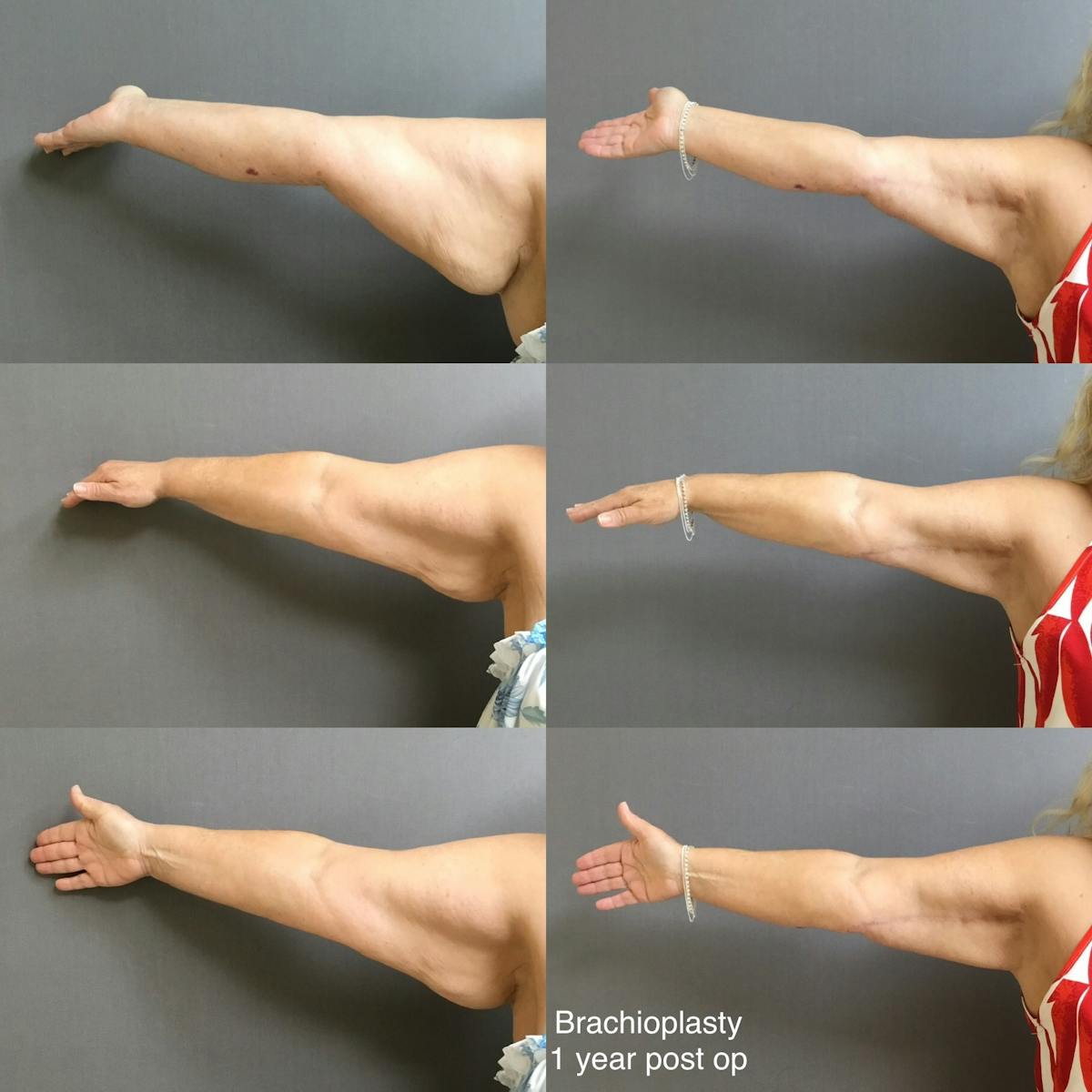 Brachioplasty Before & After Gallery - Patient 223007 - Image 5