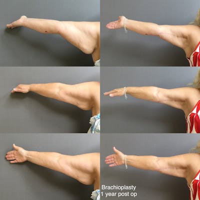 Brachioplasty Before & After Gallery - Patient 283574 - Image 1