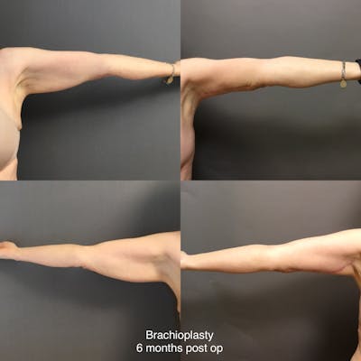 Brachioplasty Before & After Gallery - Patient 961958 - Image 1