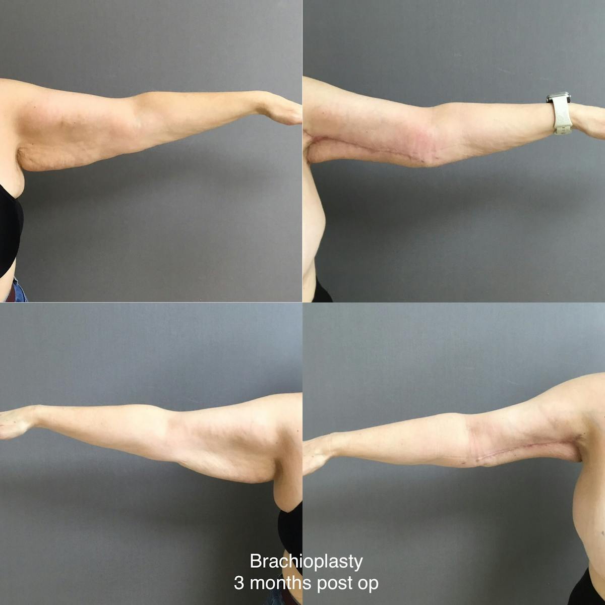 Brachioplasty Before & After Gallery - Patient 223007 - Image 1