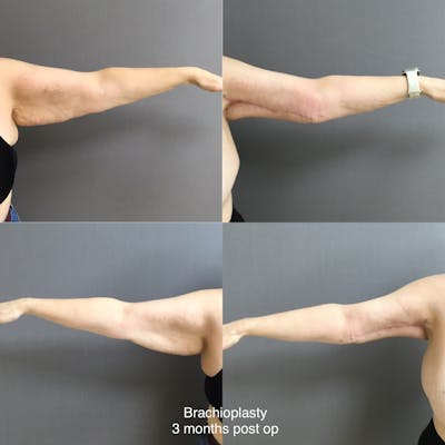 Brachioplasty Before & After Gallery - Patient 223007 - Image 1