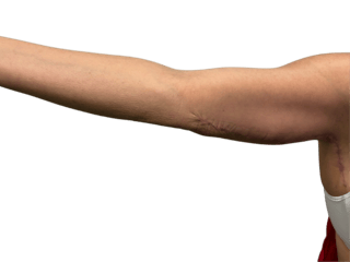 Arm Lift (Brachioplasty) Before & After Gallery - Patient 198577 - Image 4