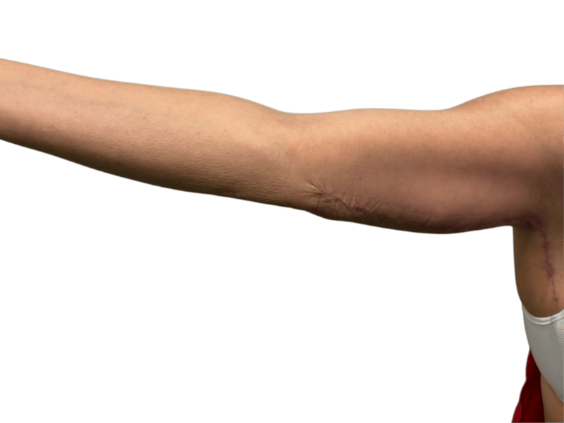 Arm Lift (Brachioplasty) Before & After Gallery - Patient 198577 - Image 4