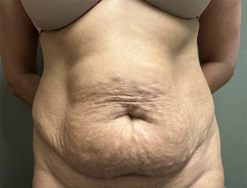 Abdominoplasty and Body Contouring Before & After Gallery - Patient 159793 - Image 1