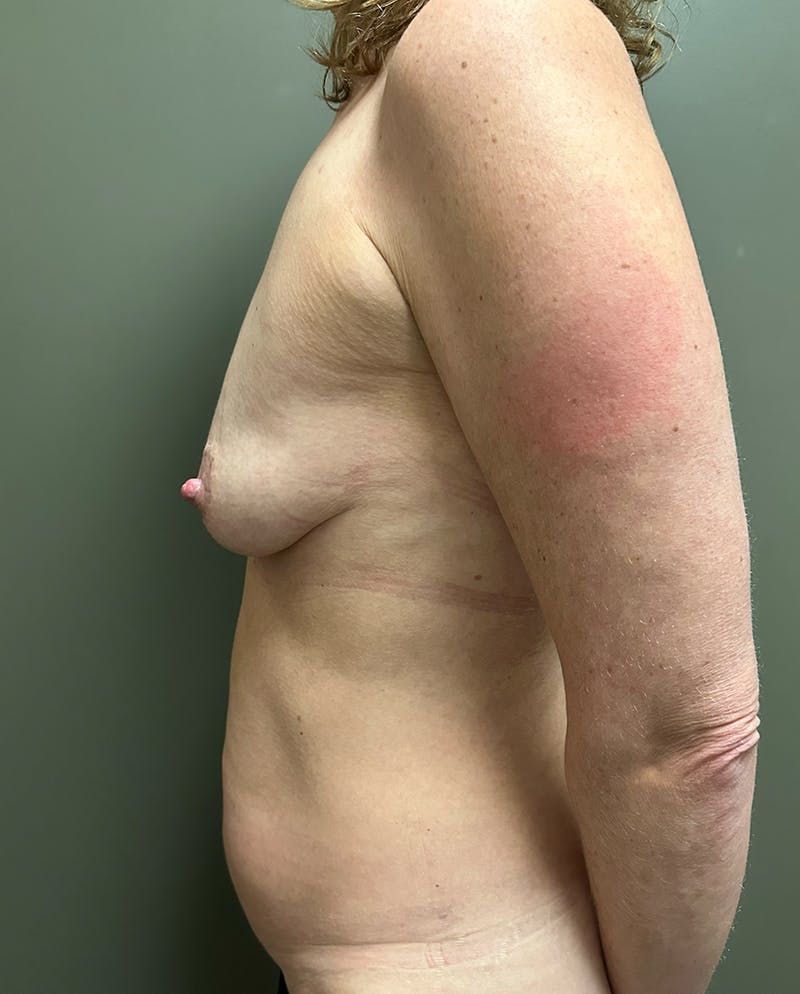 Combined Breast and Abdomen Before & After Gallery - Patient 221474 - Image 5