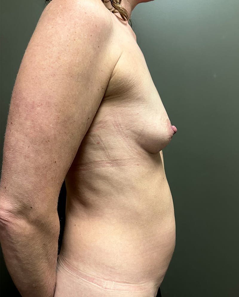 Combined Breast and Abdomen Before & After Gallery - Patient 221474 - Image 3