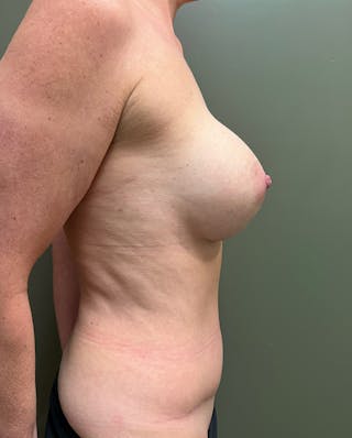 Combined Breast and Abdomen Before & After Gallery - Patient 221474 - Image 4
